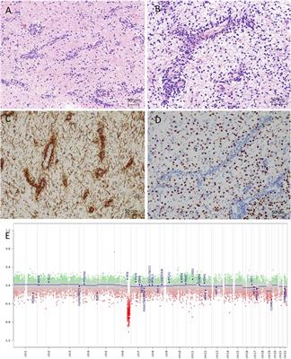 Case Report: Brainstem angiocentric glioma presenting in a toddler child–diagnostic and therapeutic challenges